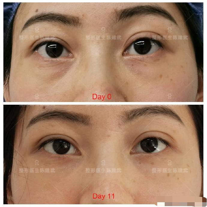 去眼袋术后出现细纹怎样修复,眼袋手术后细纹增加怎么办