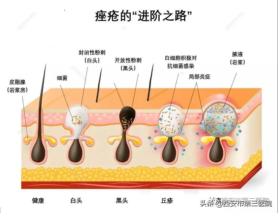 脸上全是痘真正有效的办法,脸上长小痘痘不疼不痒是什么痘