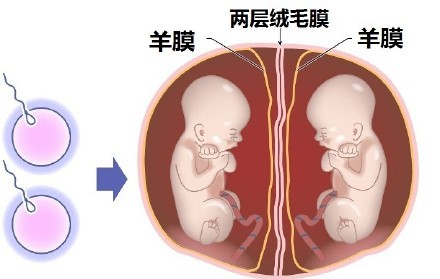 双胎需要注意的事项,双胎孕期有啥风险