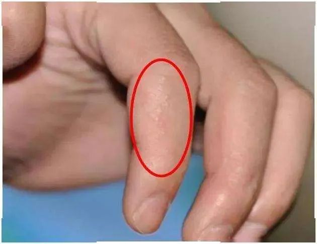 较痩来了，带你了解夏天手上经常起的小水泡是什么？