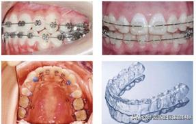 高龄整牙隐适美,整牙隐适美和钢丝牙套区别