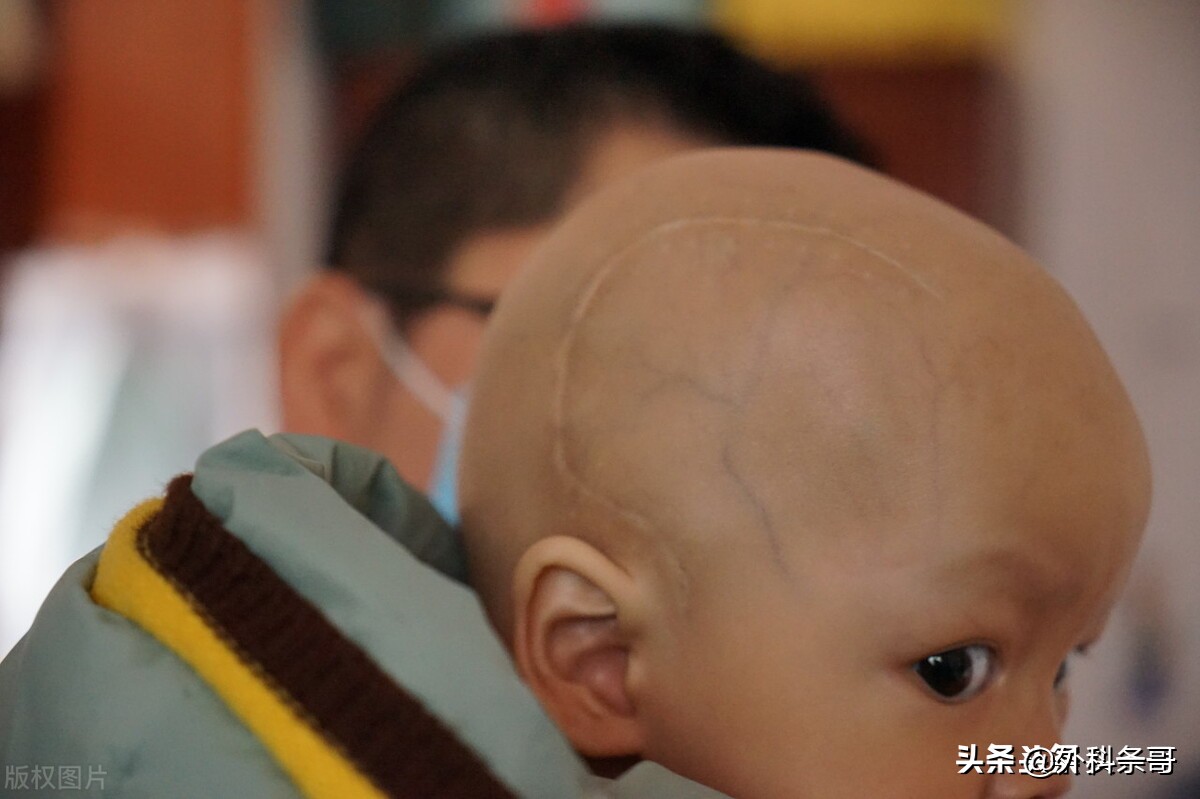 脑出血脑疝开颅手术后遗症,脑出血后遗症偏瘫能手术治疗吗