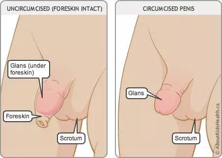包皮手术幼儿科普,男人做包皮手术