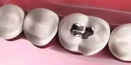 牙齿上有黑点但是不疼是怎么回事,牙齿上有小黑点但是不痛是蛀牙吗