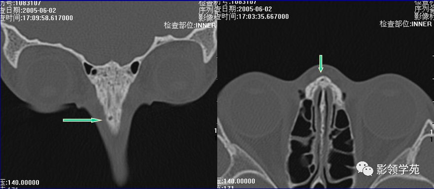 鼻骨骨折的检查方法,鼻骨骨折影像学表现
