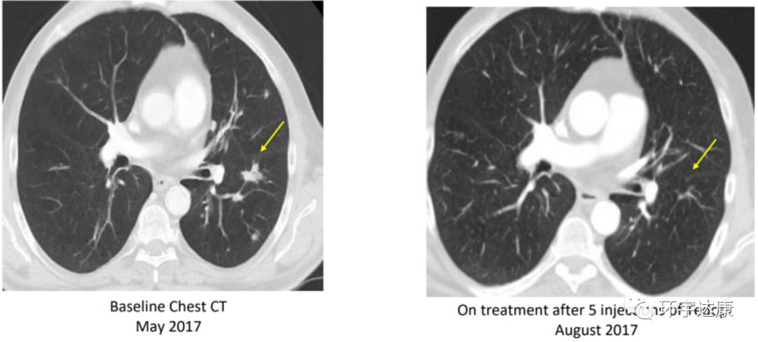 下一代癌症疫苗,肿瘤疫苗效果