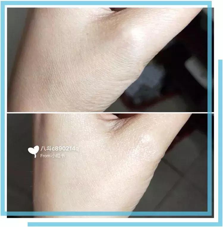 如何有效的祛痘印医美面膜,消炎祛痘的医美面膜