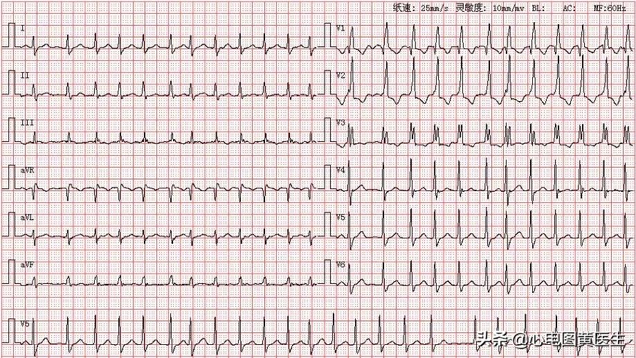 三度房室传导阻滞，房室干扰性脱节，怎么看？