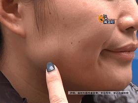 打完瘦脸针青蛙腮多久消失,打完瘦脸针出现哇噻是因为什么