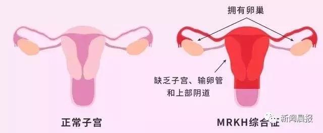 “借”母亲子宫,女子成功生下自己的宝宝网友:男人生娃岂不是指日可待!
