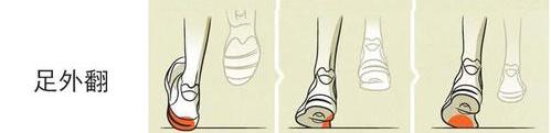 偏瘫足内翻足外翻,足内翻足外翻崴脚