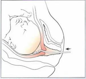 第26讲，催生方法有哪些？