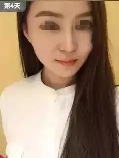 解密瘦脸针的几大常识性问题,关于瘦脸针的真实事件