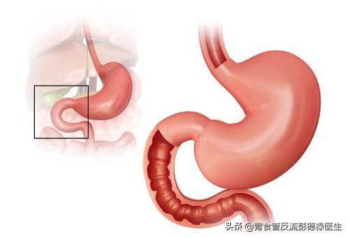 彭医生得什么病,陈明讲慢性胃炎怎么治