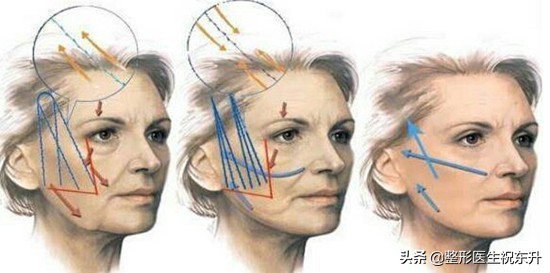 面部线雕一般能保持多久,医生不建议做线雕的原因
