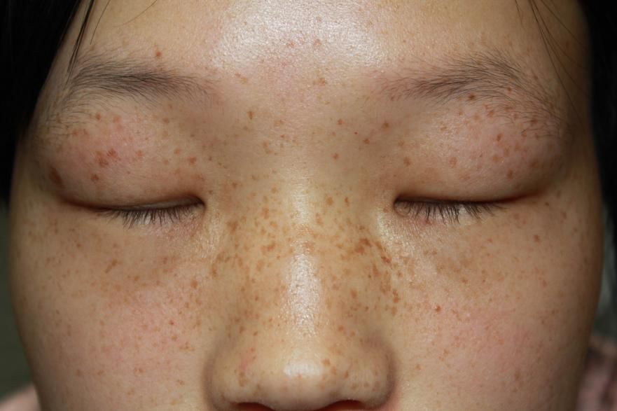 脸上雀斑越来越多怎么调理,脸上雀斑的原因与调理