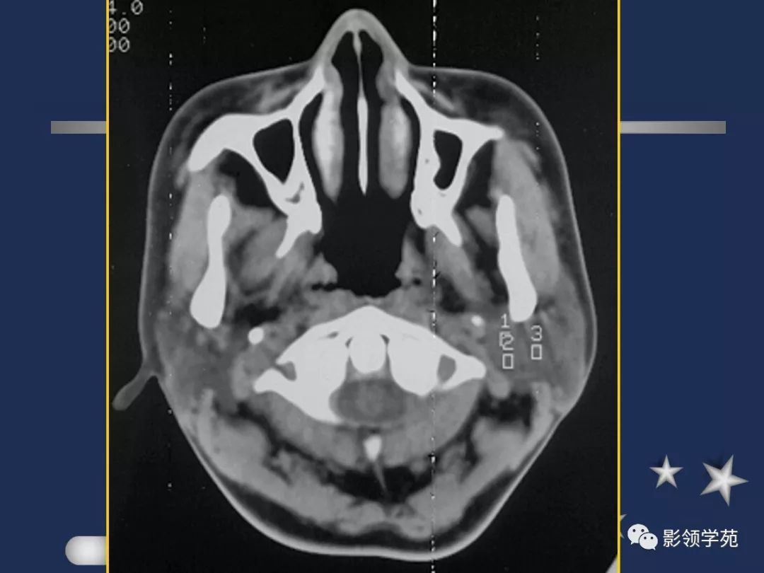 腮腺疾病影像学诊断,腮腺肿块影像诊断