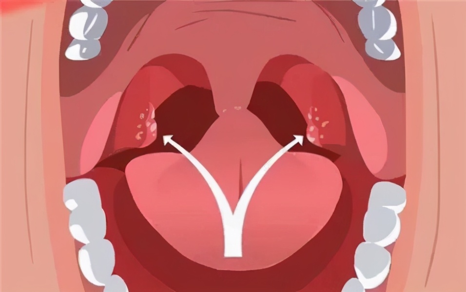 慢性咽炎喉咙痛干燥怎么办,上火导致咽炎吃什么药有效