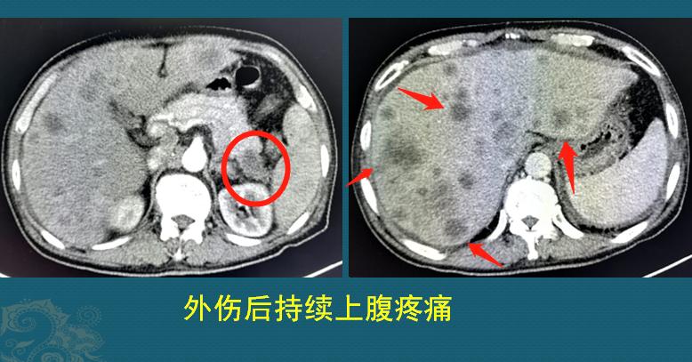 32岁女子抗癌19年相继患上5种癌,癌细胞转移最难治疗方法