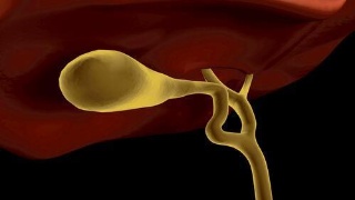 又有胃病又有胆结石怎样注意饮食,胆结石引起的胰腺炎饮食注意什么