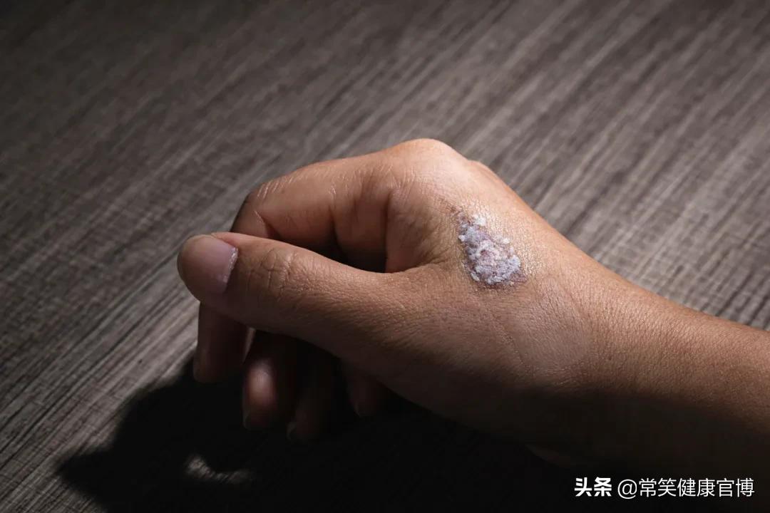 烧烫伤膏治疗一般的烫伤多久会好,缓解烫伤恢复阶段疼痛的办法