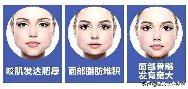 脸型侧边扁平怎么改善,方脸下颌骨宽大怎么改善