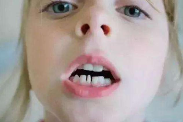 牙齿矫正可以改变脸型吗,牙齿矫正对脸型变化大吗