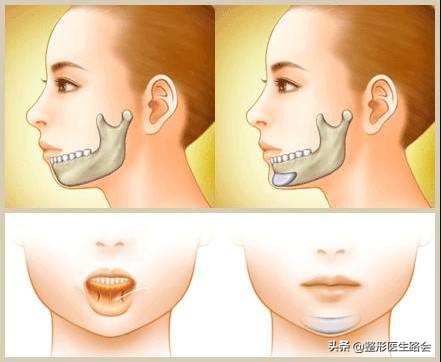 有几种下巴,有三个下巴是为什么