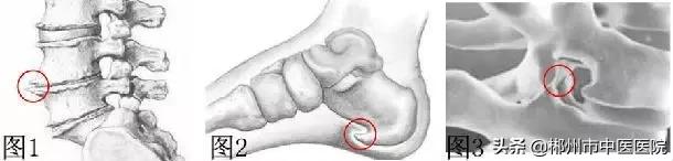 骨刺是补钙过度造成的吗,骨刺不处理要不要紧