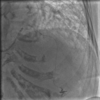 85岁老人心脏堵塞,77岁老人冠脉狭窄放支架还是搭桥