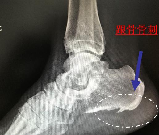 足跟痛无创治疗,足跟痛的神奇有效方法