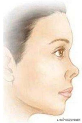 没鼻梁耳软骨隆鼻可以吗,肋软骨隆鼻鼻子好堵