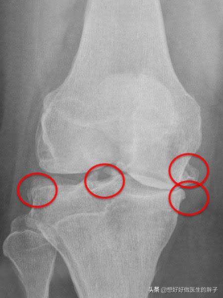 膝盖怎样知道有骨刺,膝盖有骨刺中医怎么治