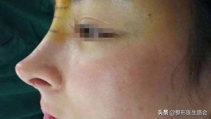 鼻子高的人正面看不是很好看,过于高挺突兀的鼻子