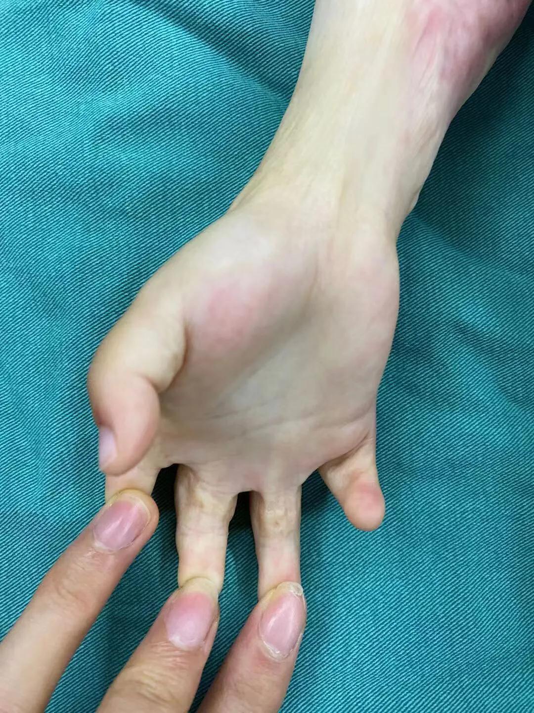 儿童烫伤的疤痕,三度烫伤疤痕为啥挛缩