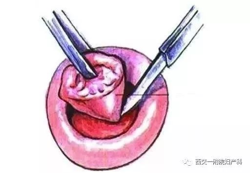 宫颈锥切手术后白带异常,宫颈锥切手术能吃猪油吗
