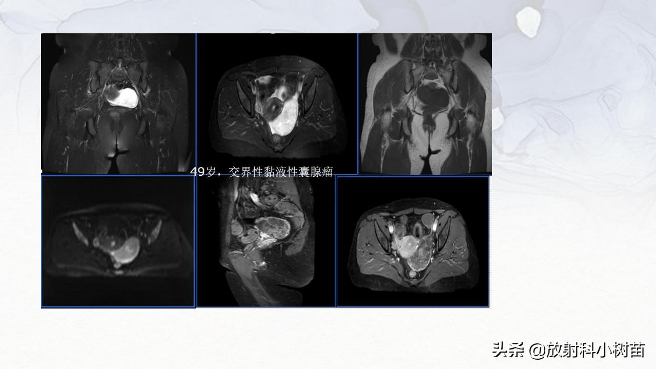 女性盆腔mri解剖图谱,泌尿生殖系统x线解剖