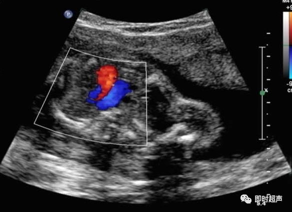 胎儿心脏三种血管关系模式图,25周的胎儿心脏弓切面多少正常