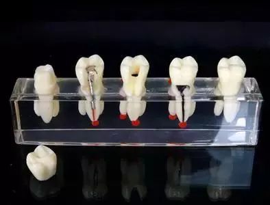 根管治疗后牙齿劈裂怎么办最好,戴冠后牙会不会劈裂