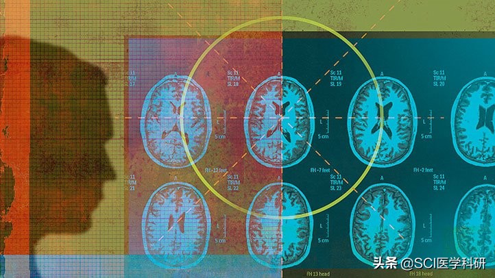 多发性硬化mri典型表现,多发性硬化症ms试验