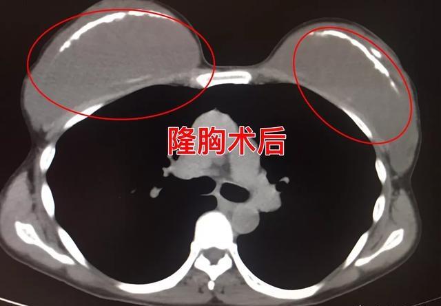 肺部ct检查一般都能发现什么问题,肺部检查应该拍片还是应该做肺ct