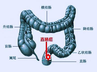 直肠癌放疗中的注意事项