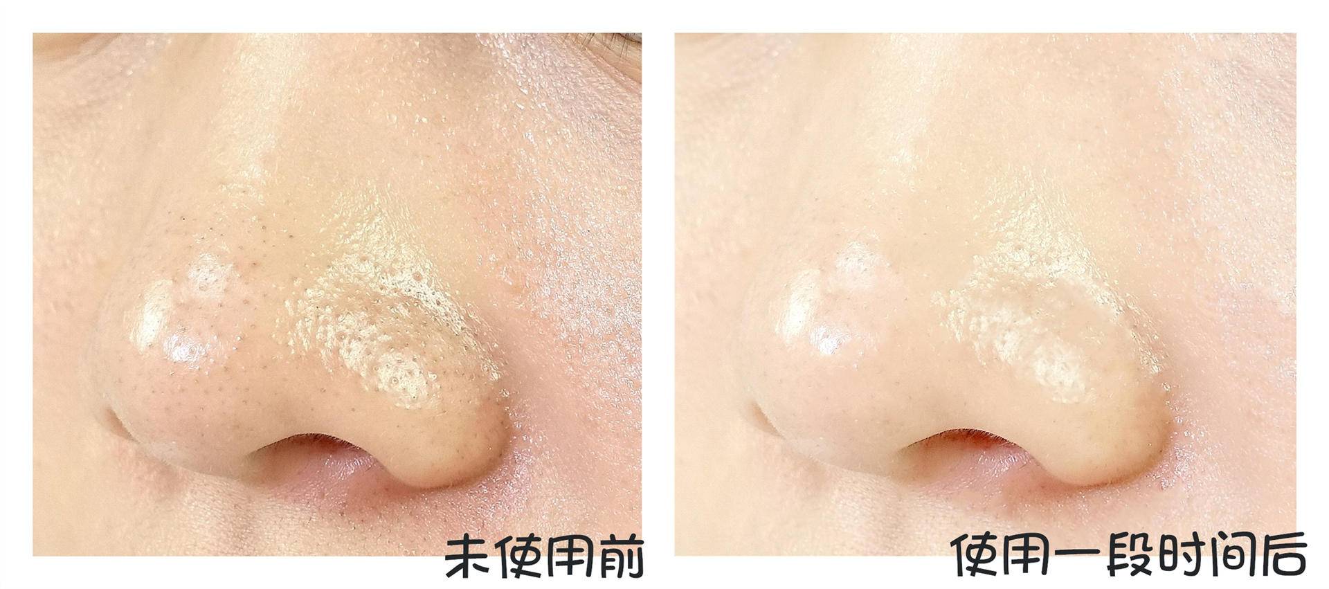 水杨酸毛孔收敛水湿敷,渡美毛孔收敛水湿敷多久