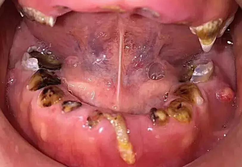 小黑点的蛀牙不严重吗,蛀牙了一点点黑色也得补么