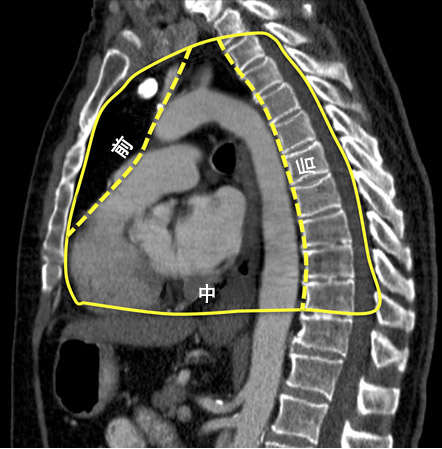 纵隔解剖3d,纵隔窗影像解剖图示