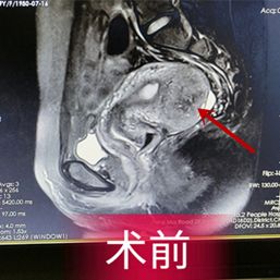 消除子宫肌瘤可用中药治疗吗,消除子宫肌瘤的特效药