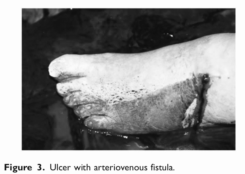 静脉大出血是怎么回事,肝硬化胃部静脉曲张导致大出血