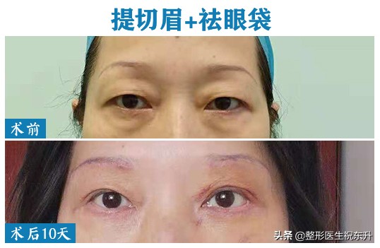 切眉一个月后眼皮痒是怎么回事,做完切眉手术眼睛红肿怎么回事