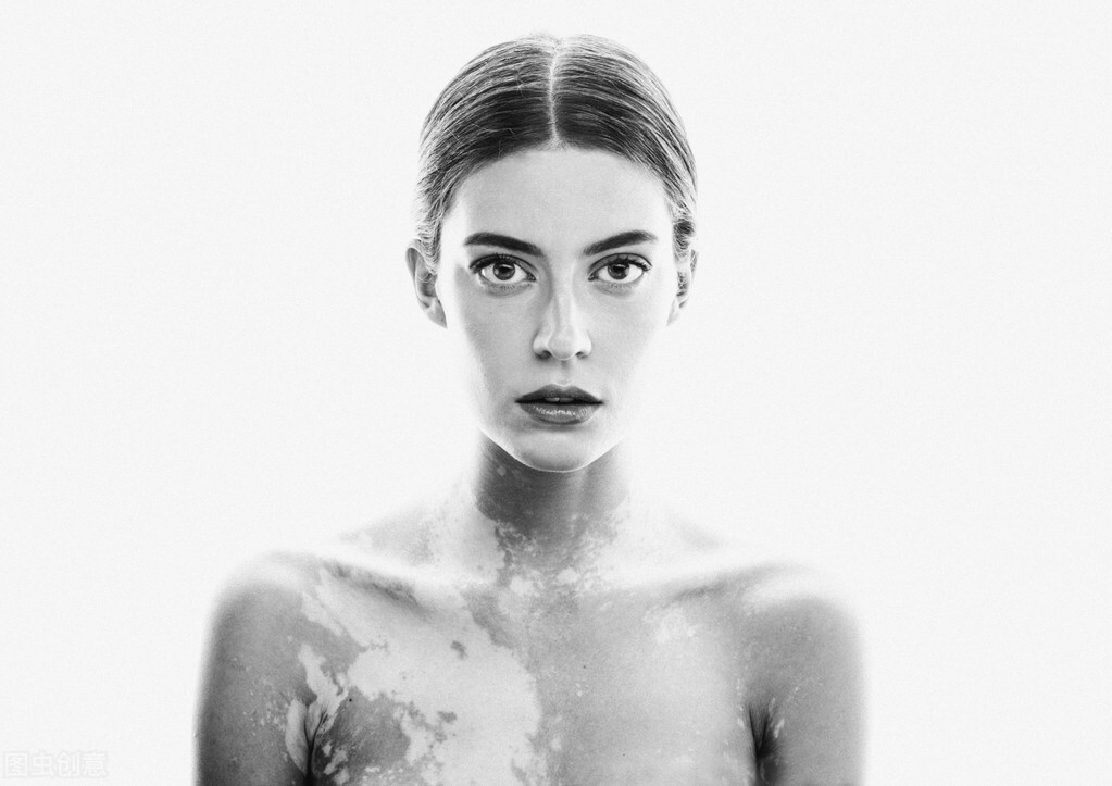 黑豆怎么吃治白癜风,吃黑色素对白癜风有帮助