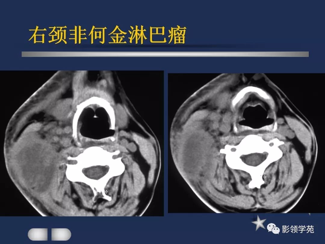 腮腺疾病影像学诊断,腮腺肿块影像诊断